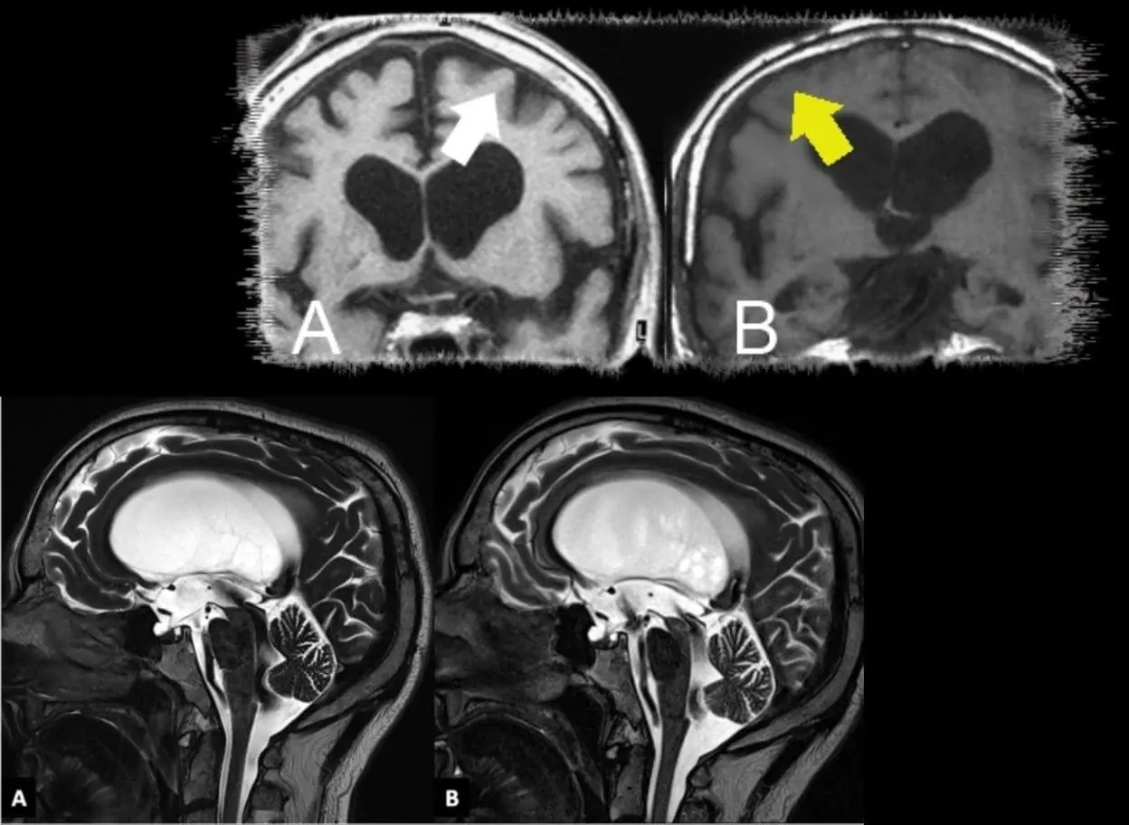 Long standing Overt Ventriculomegaly in Adults (LOVA)