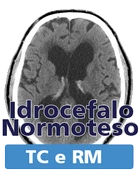 TC RM idrocefalo normoteso idiopatico