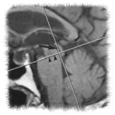 acquedotto diagnostica per immagini idrocefalo normoteso idiopatico stroke volume