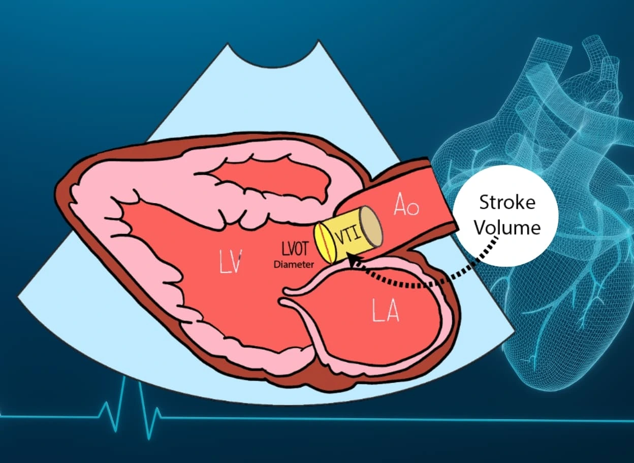 Studio dello Stroke Volume nel management dell’Idrocefalo Normoteso