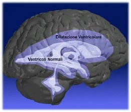dilatazione ventricolare idrocefalo normoteso idiopatico