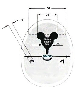 idrocefalo normoteso idiopatico indici TC RM