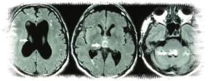 idrocefalo normoteso idiopatico diagnostica immagini