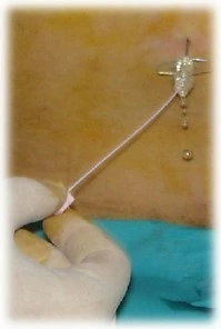 idrocefalo normoteso idiopatico test selezione tap test