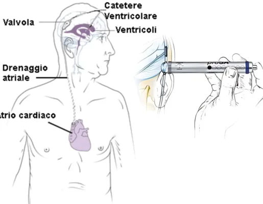 Valvole Programmabili e Trattamento Idrocefalo Normoteso
