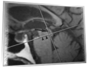 acquedotto diagnostica per immagini idrocefalo normoteso idiopatico stroke volume